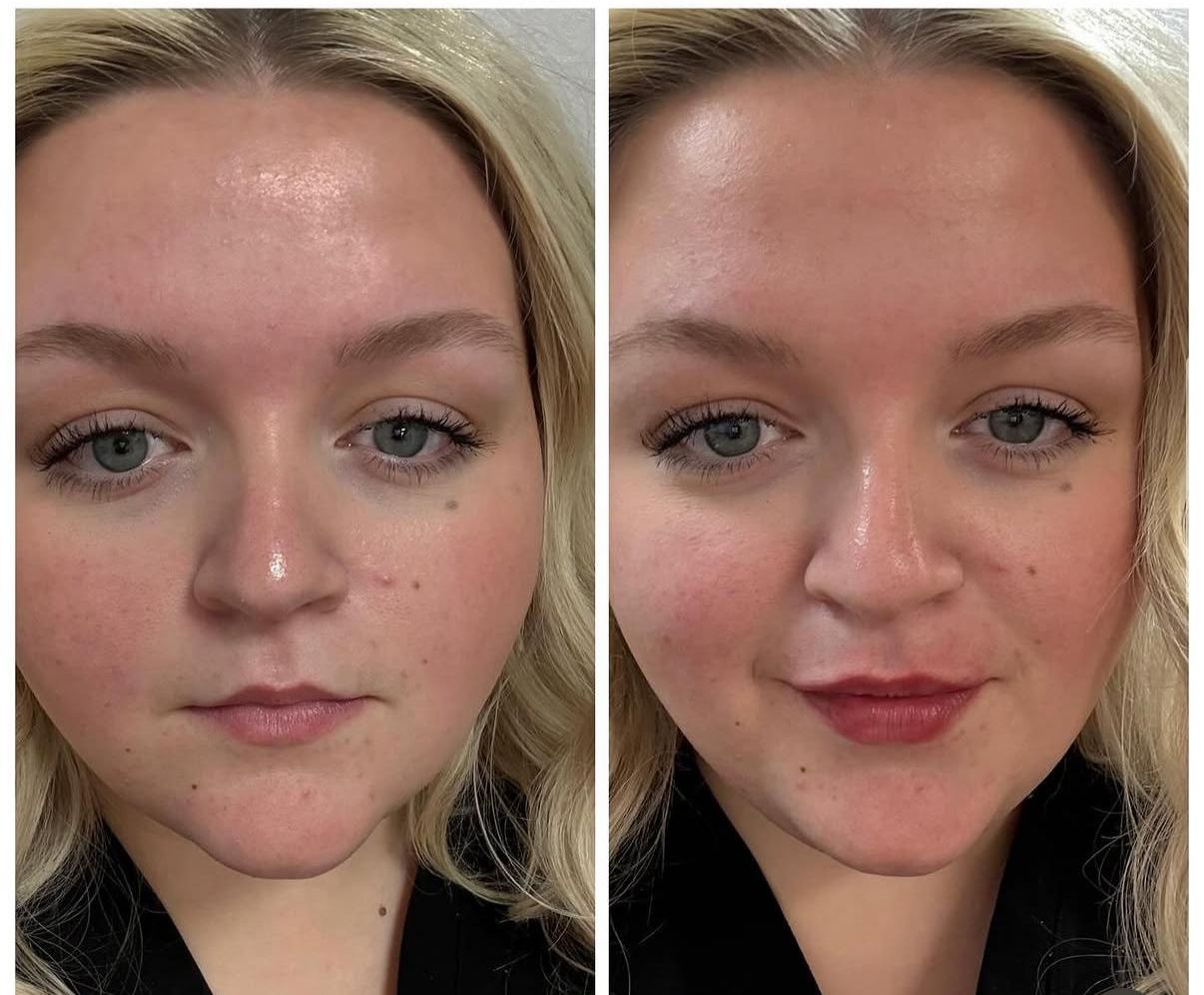 Subtle, natural lip enhancement — before and after